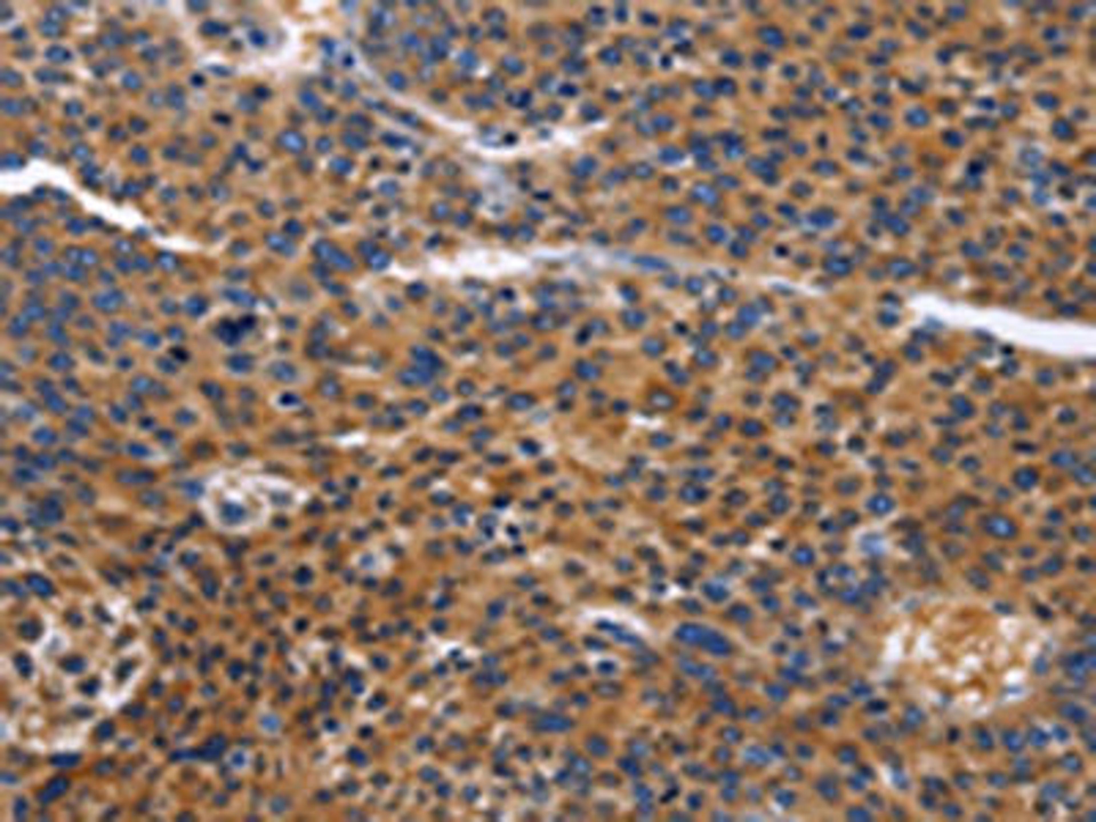 The image on the left is immunohistochemistry of paraffin-embedded Human liver cancer tissue using CSB-PA206692(ACVR2B Antibody) at dilution 1/50, on the right is treated with fusion protein. (Original magnification: ×200)