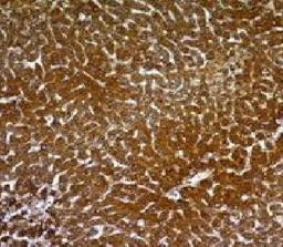 Immunohistochemical staining of human Hepatocellular carcinoma tissue using Hepatocyte Specific Antigen antibody