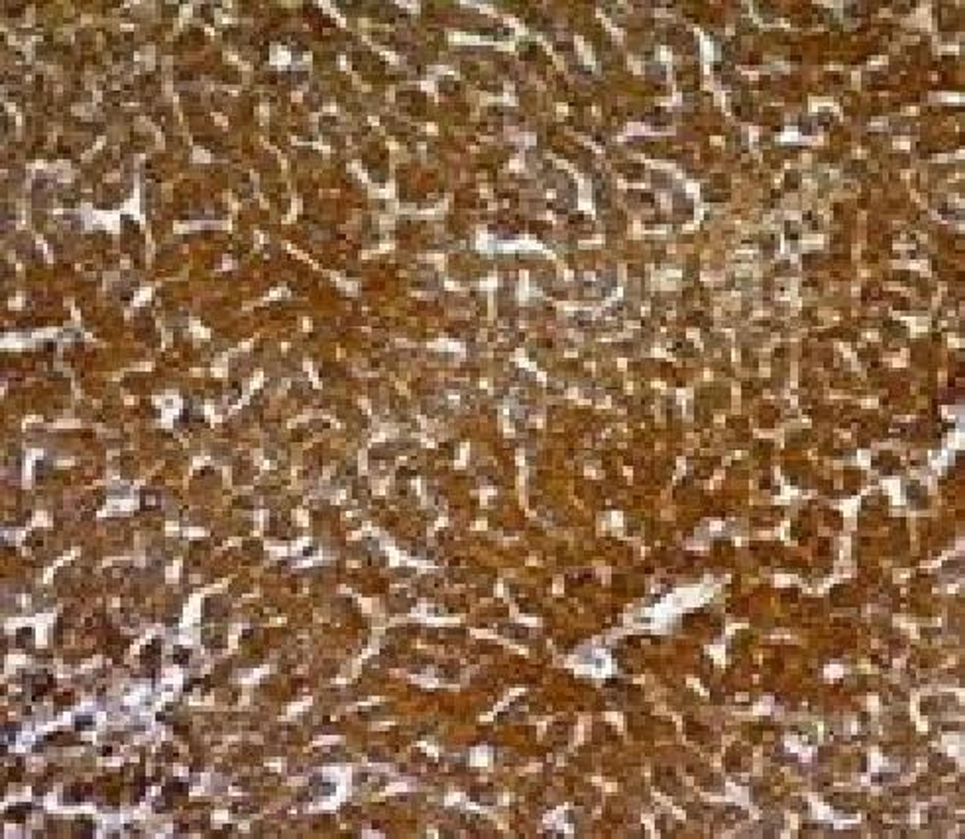 Immunohistochemical staining of human Hepatocellular carcinoma tissue using Hepatocyte Specific Antigen antibody