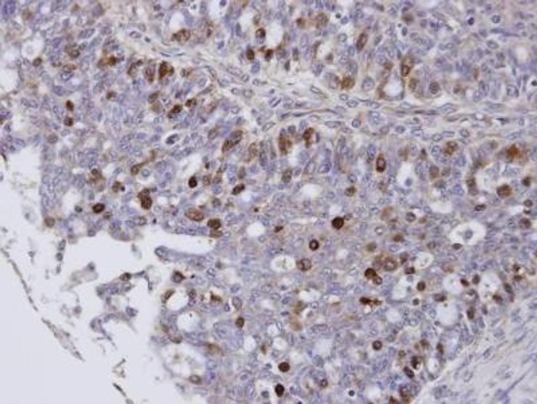 Immunohistochemistry-Paraffin: FoxM1 Antibody [NBP1-30961] -  Paraffin-embedded OVCA, using antibody at 1:100 dilution.