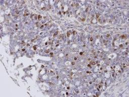 Immunohistochemistry-Paraffin: FoxM1 Antibody [NBP1-30961] -  Paraffin-embedded OVCA, using antibody at 1:100 dilution.