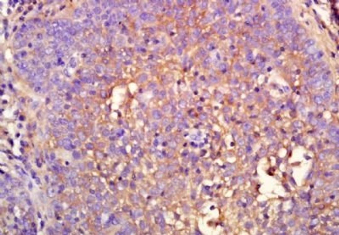 Immunohistochemical analysis of formalin-fixed paraffin embedded human laryngocarcinoma tissue using KMT6 (phospho-Thr487) antibody (dilution at 1:200)