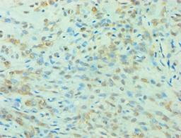 Immunohistochemistry of paraffin-embedded human breast cancer using CSB-PA026290ESR2HU at dilution of 1:100