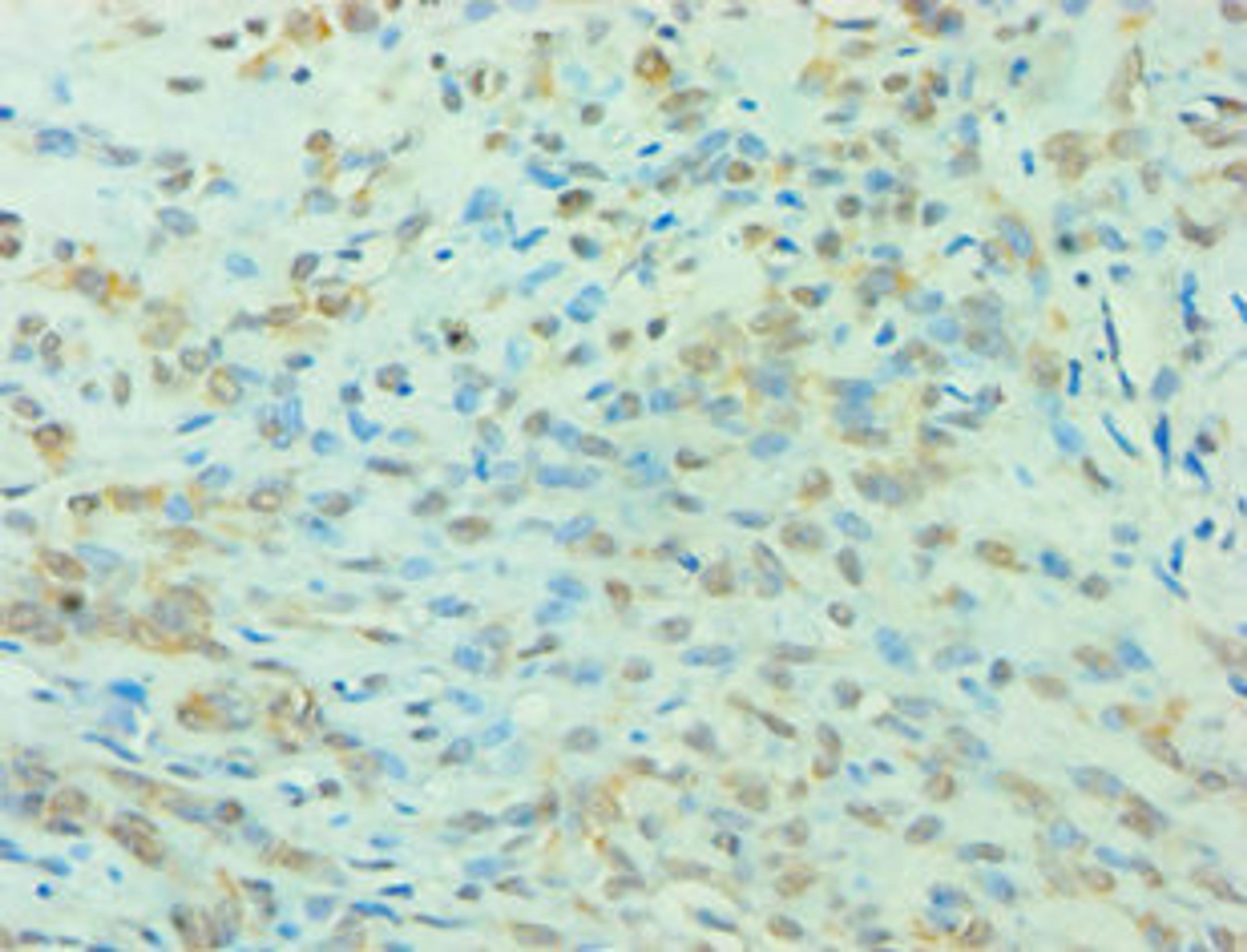 Immunohistochemistry of paraffin-embedded human breast cancer using CSB-PA026290ESR2HU at dilution of 1:100