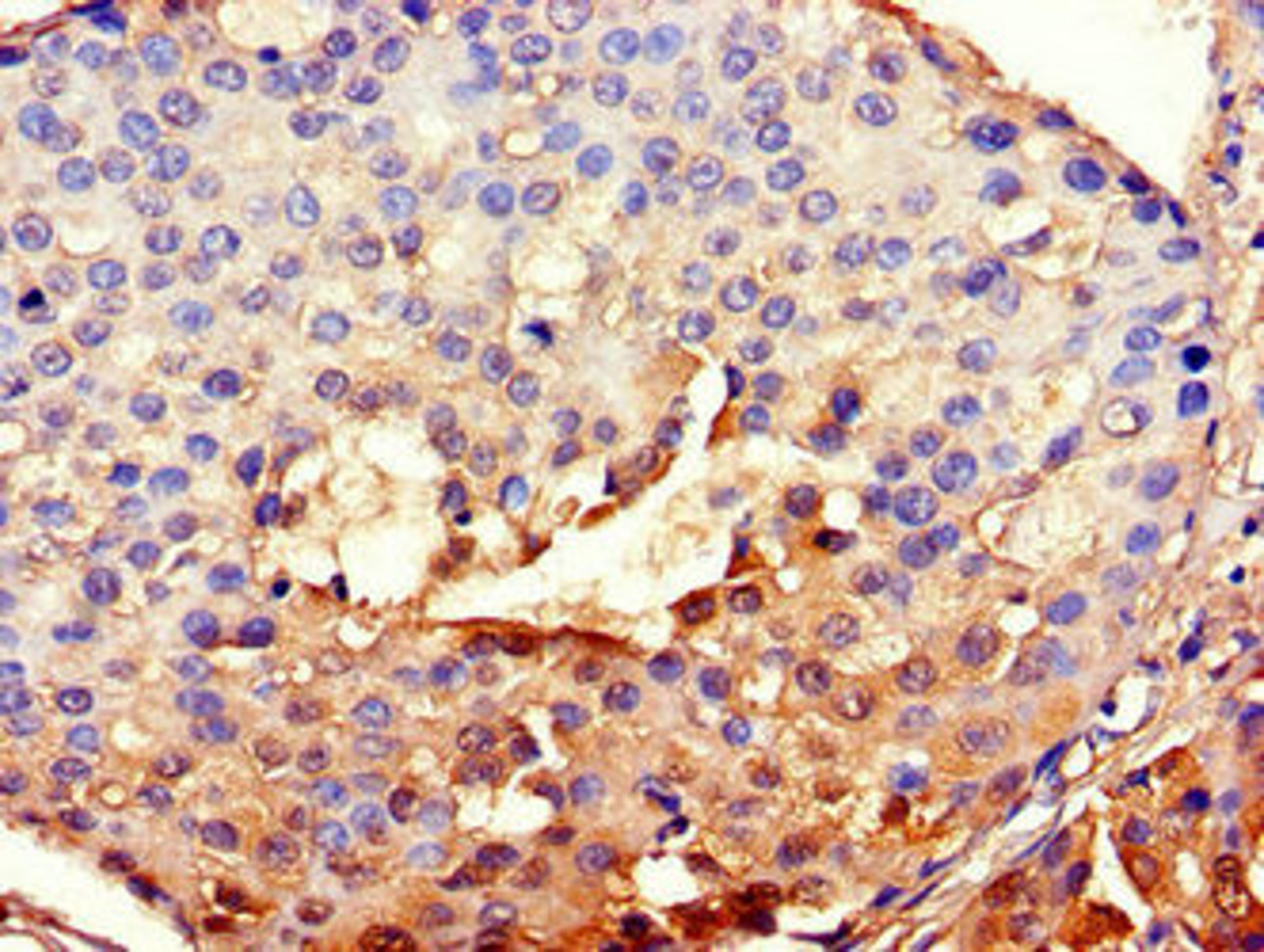 Immunohistochemistry of paraffin-embedded human breast cancer using CSB-PA002691LA01HU at dilution of 1:100