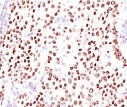 IHC testing of FFPE human breast carcinoma with Progesterone receptor antibody (clone PGSR17).