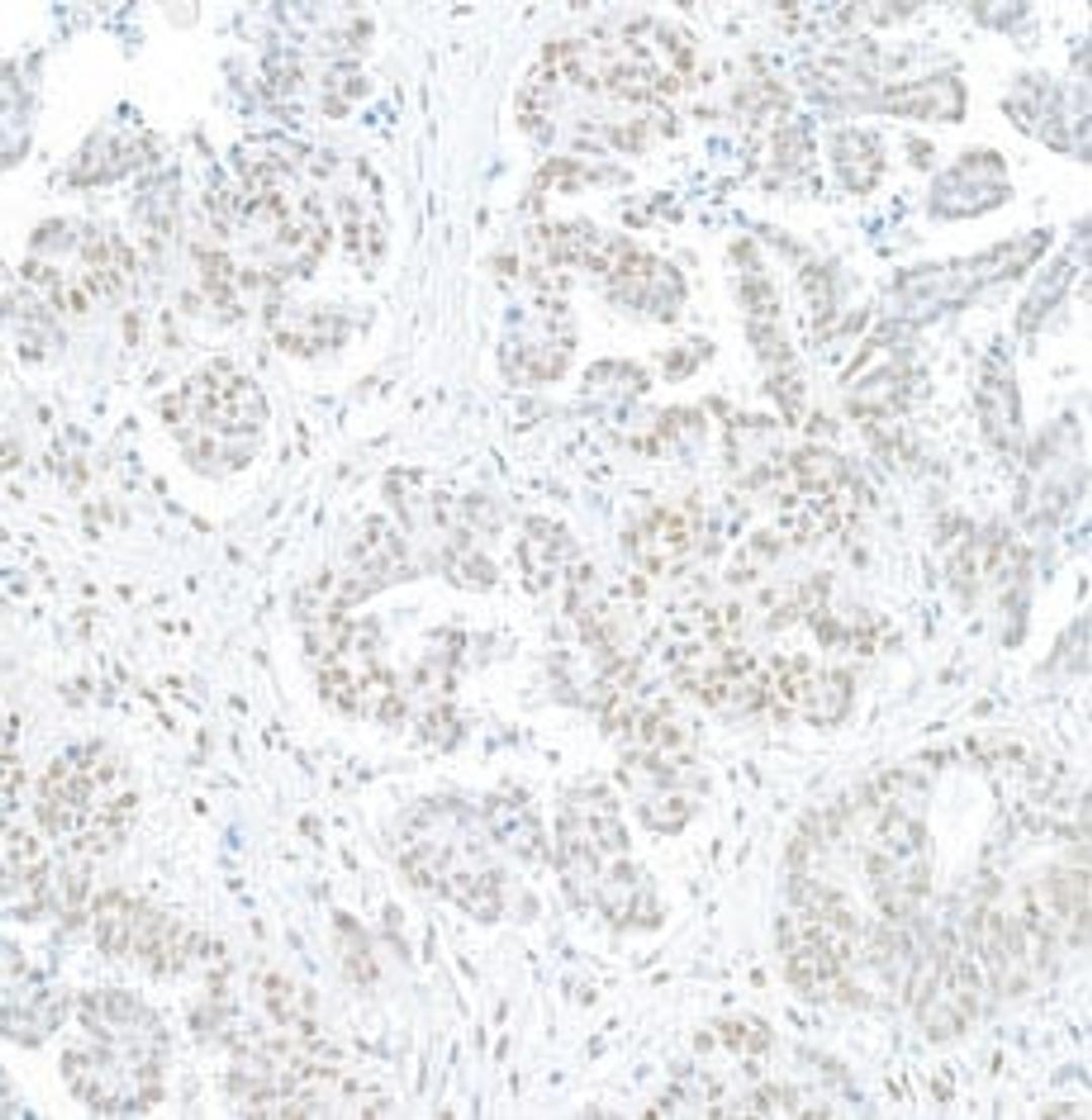 Detection of human BRG1/SMARCA4 by immunohistochemistry.