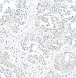 Detection of human BRG1/SMARCA4 by immunohistochemistry.