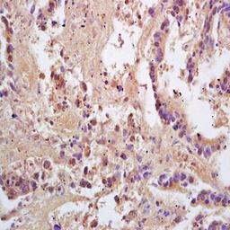 Immunohistochemical analysis of formalin-fixed and paraffin embedded human colon carcinoma tissue (dilution at:1:200) using PACAP 27/38 antibody