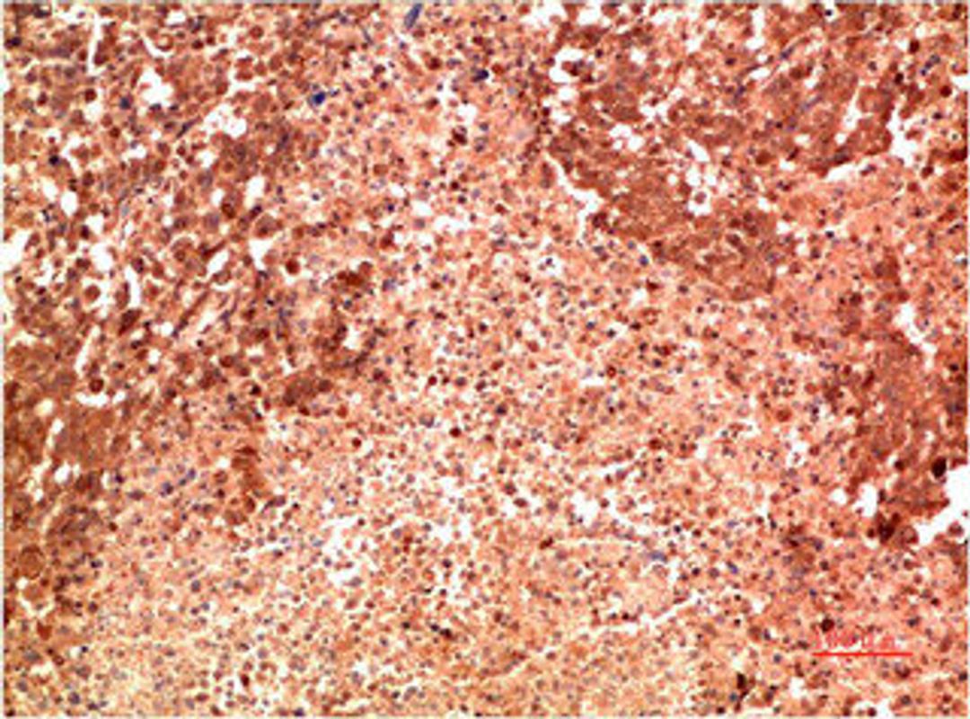 Immunohistochemical analysis of paraffin-embedded Human Lung Carcinoma Tissue using P38  Mouse mAb diluted at 1:200.