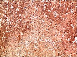 Immunohistochemical analysis of paraffin-embedded Human Lung Carcinoma Tissue using P38  Mouse mAb diluted at 1:200.