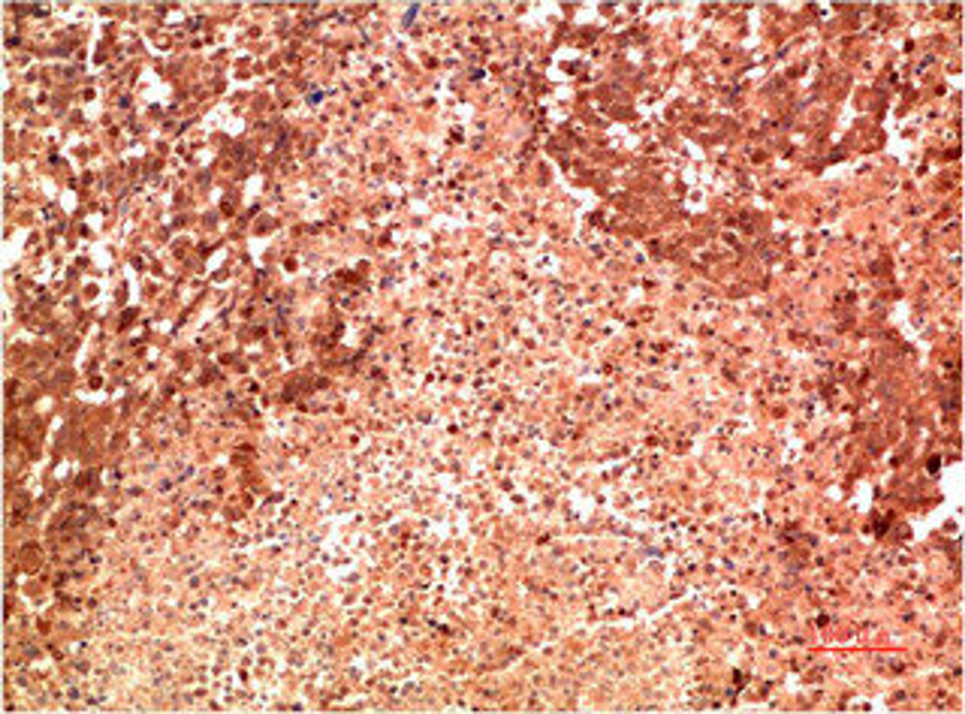 Immunohistochemical analysis of paraffin-embedded Human Lung Carcinoma Tissue using P38  Mouse mAb diluted at 1:200.