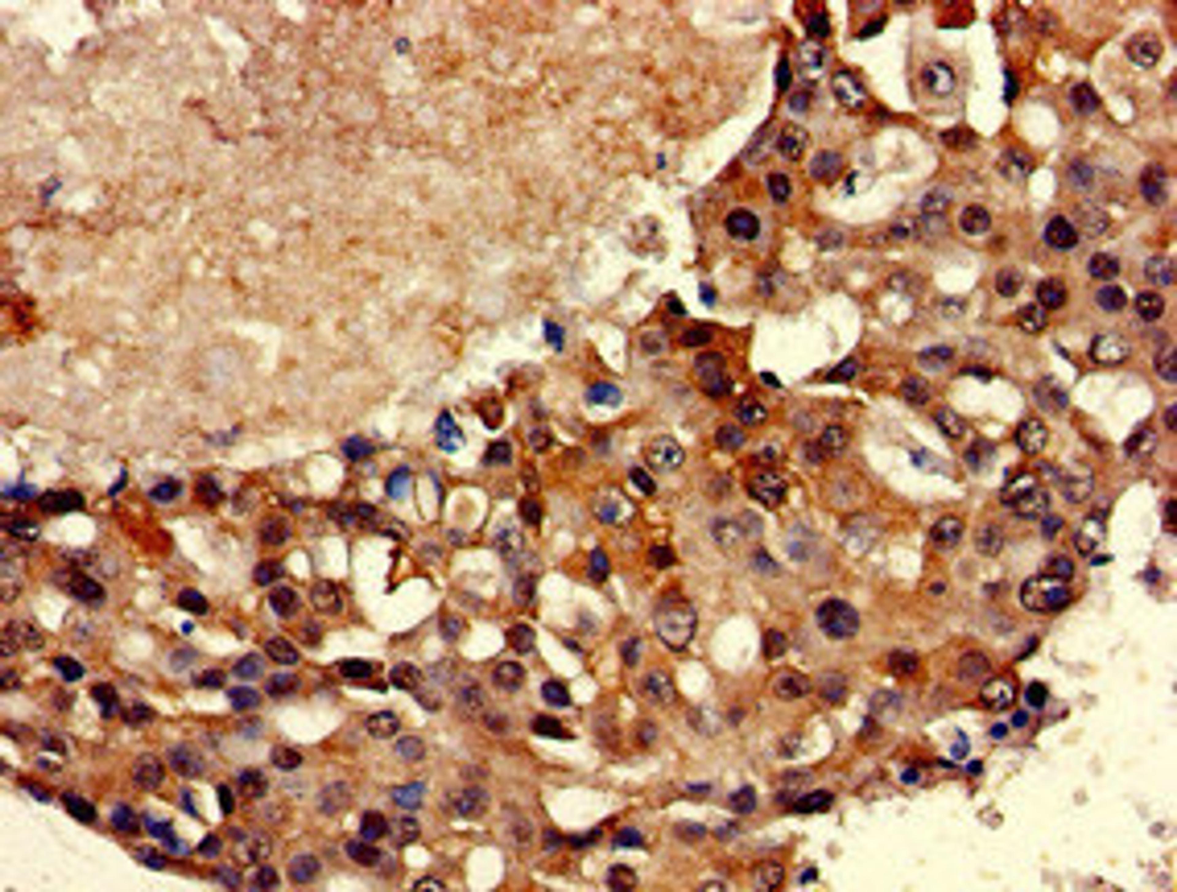 Immunohistochemistry of paraffin-embedded human breast cancer using CSB-PA023239HA01HU at dilution of 1:100