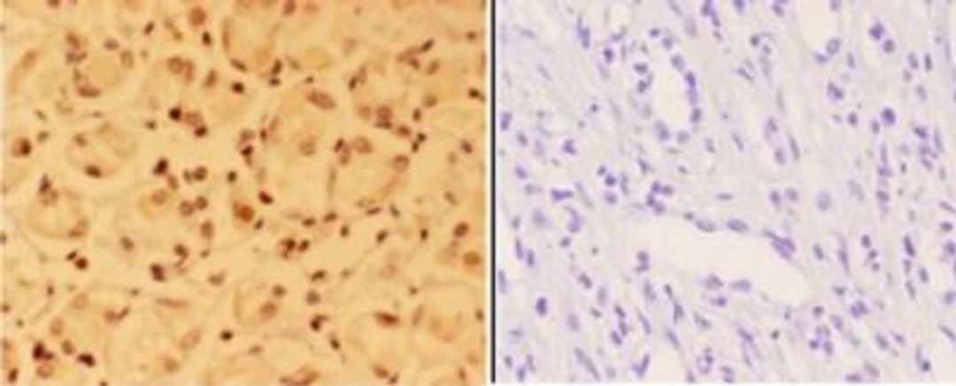 Immunohistochemistry-Paraffin: ALX3 Antibody [NB100-92297] - Paraffin-embedded human kidney carcinoma tissue at 1:50,showing nucleus staining. Negative control (the right) Using PBS instead of primary antibody, secondary antibody is Goat Anti-Rabbit IgG-biotin