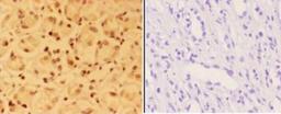 Immunohistochemistry-Paraffin: ALX3 Antibody [NB100-92297] - Paraffin-embedded human kidney carcinoma tissue at 1:50,showing nucleus staining. Negative control (the right) Using PBS instead of primary antibody, secondary antibody is Goat Anti-Rabbit IgG-biotin