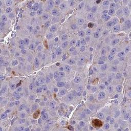 Immunohistochemistry: C5orf51 Antibody [NBP2-32025] - liver cancer