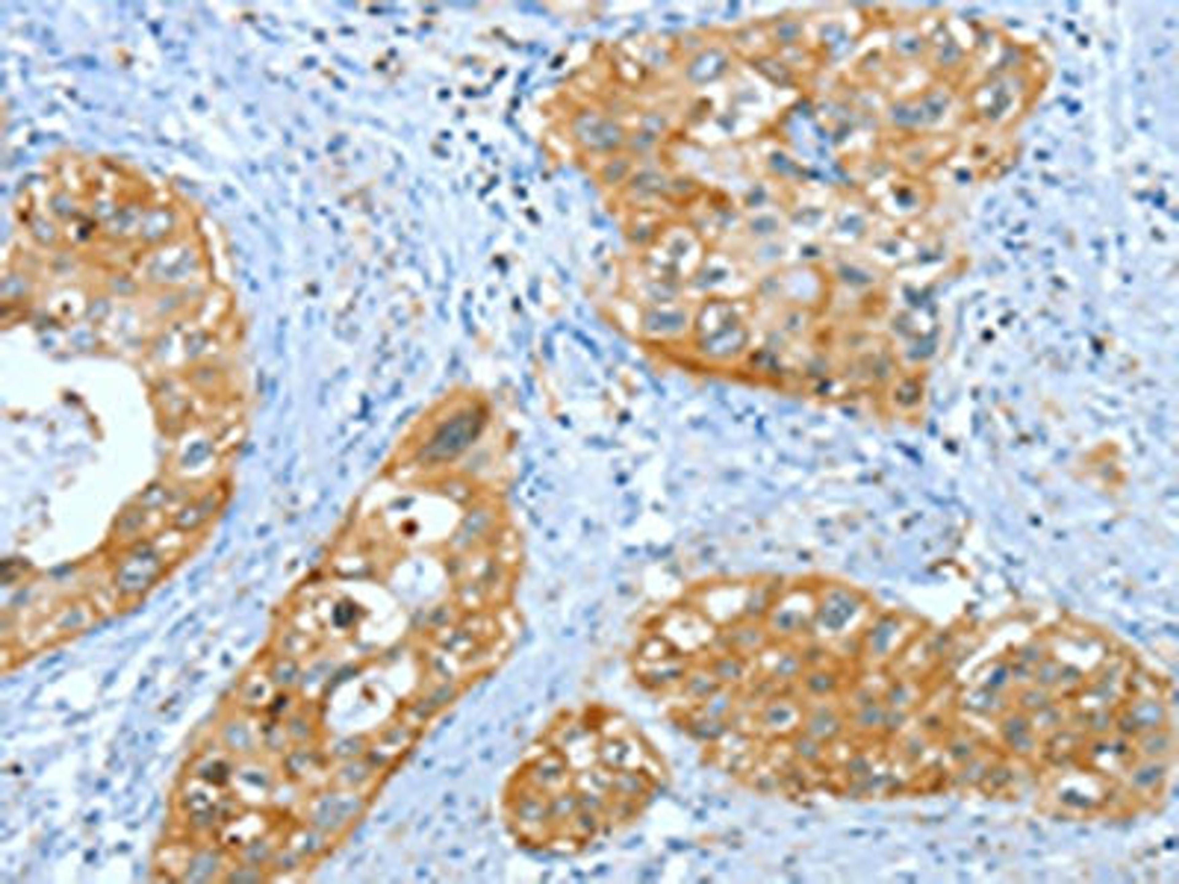 The image on the left is immunohistochemistry of paraffin-embedded Human cervical cancer tissue using CSB-PA195186(ANXA3 Antibody) at dilution 1/35, on the right is treated with fusion protein. (Original magnification: ×200)