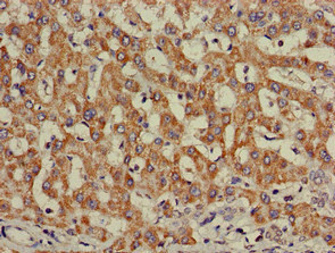 Immunohistochemistry of paraffin-embedded human liver cancer using CSB-PA011753LA01HU at dilution of 1:100