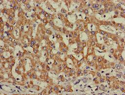 Immunohistochemistry of paraffin-embedded human liver cancer using CSB-PA011753LA01HU at dilution of 1:100