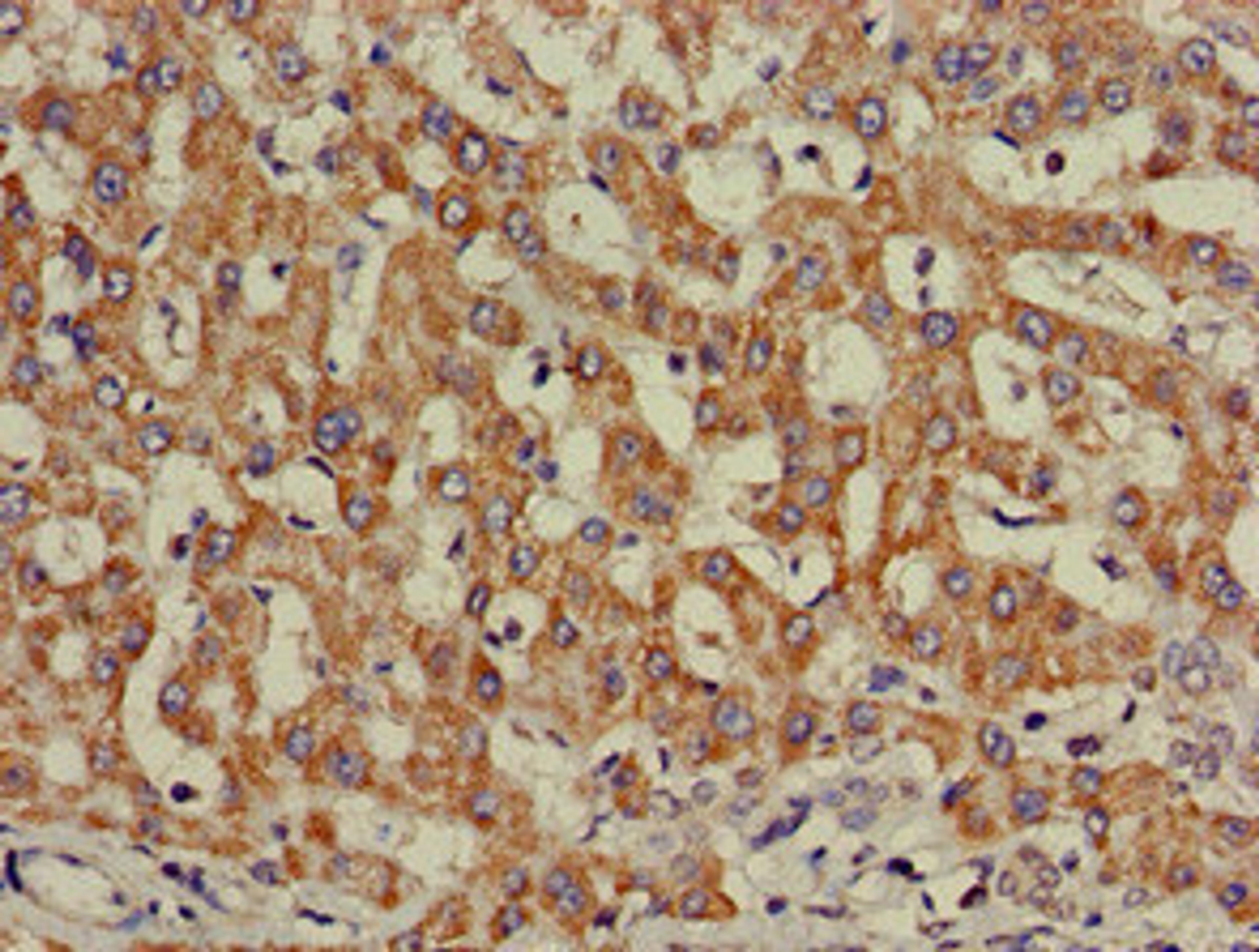 Immunohistochemistry of paraffin-embedded human liver cancer using CSB-PA011753LA01HU at dilution of 1:100