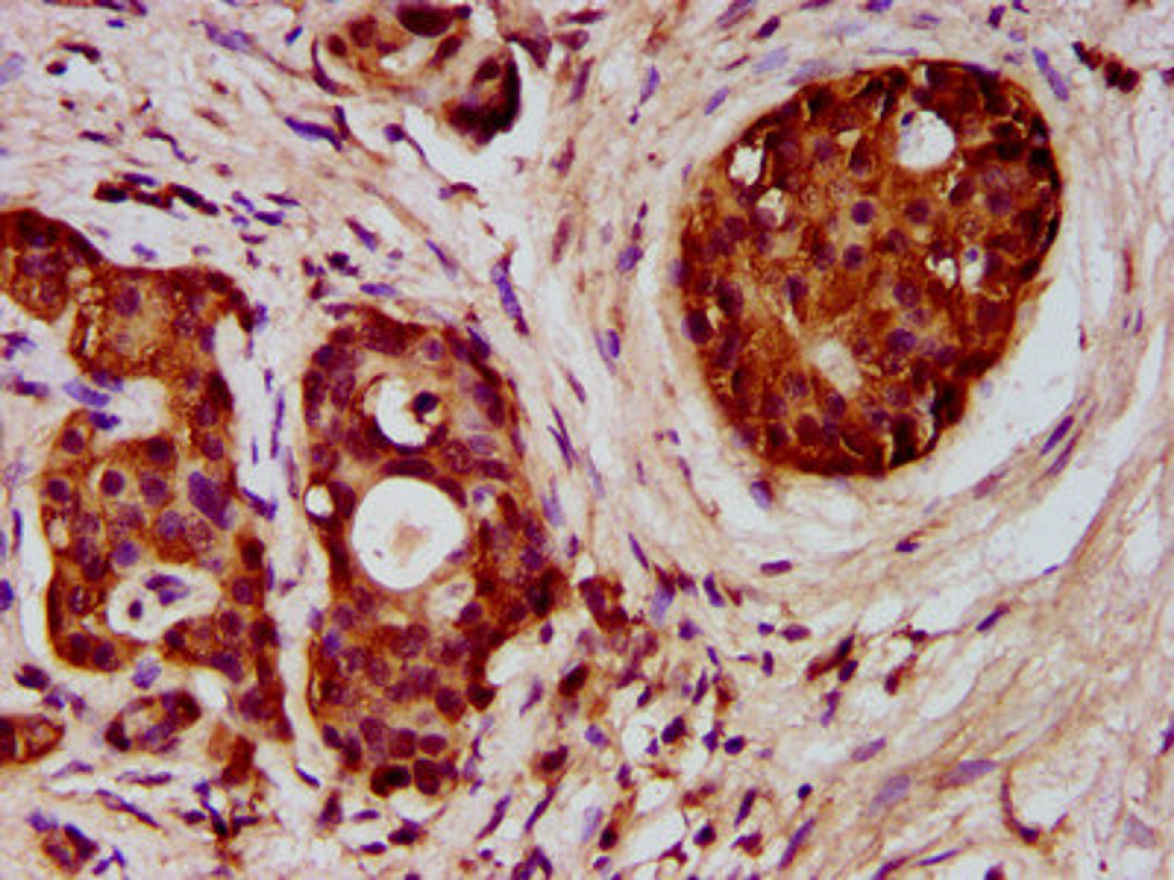 IHC image of CSB-PA008546LA01HU diluted at 1:300 and staining in paraffin-embedded human pancreatic cancer performed on a Leica BondTM system. After dewaxing and hydration, antigen retrieval was mediated by high pressure in a citrate buffer (pH 6.0). Section was blocked with 10% normal goat serum 30min at RT. Then primary antibody (1% BSA) was incubated at 4&deg;C overnight. The primary is detected by a biotinylated secondary antibody and visualized using an HRP conjugated SP system.