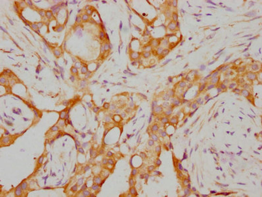 IHC image of CSB-RA019338A0HU diluted at 1:155 and staining in paraffin-embedded human breast cancer performed on a Leica BondTM system. After dewaxing and hydration, antigen retrieval was mediated by high pressure in a citrate buffer (pH 6.0). Section was blocked with 10% normal goat serum 30min at RT. Then primary antibody (1% BSA) was incubated at 4℃ overnight. The primary is detected by a biotinylated secondary antibody and visualized using an HRP conjugated SP system.
