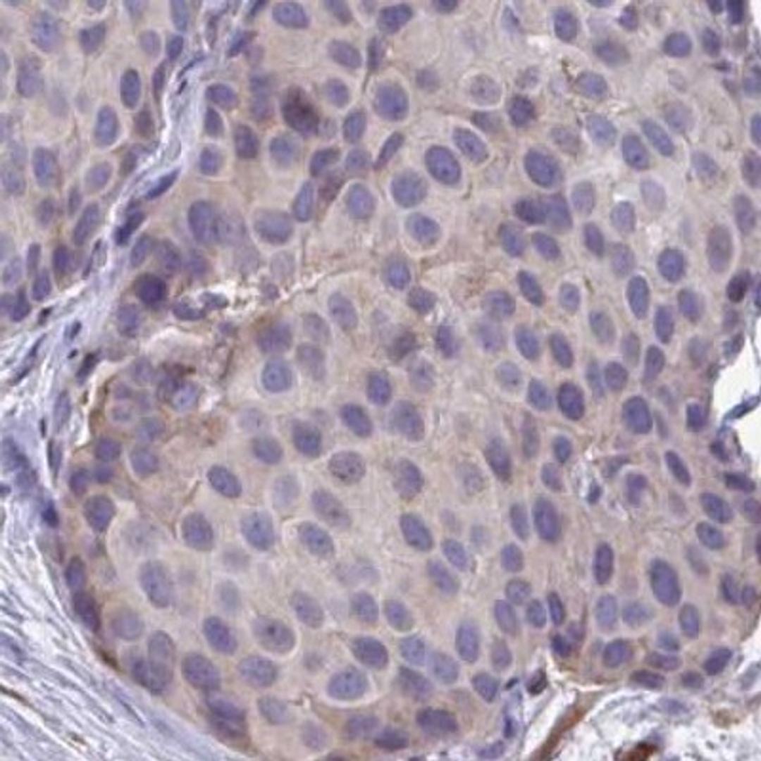 Immunohistochemistry: C5orf46 Antibody [NBP2-32412] - breast cancer