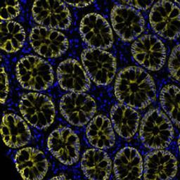 Detection of human EpCAM in FFPE colon carcinoma by immunohistochemistry-IF.