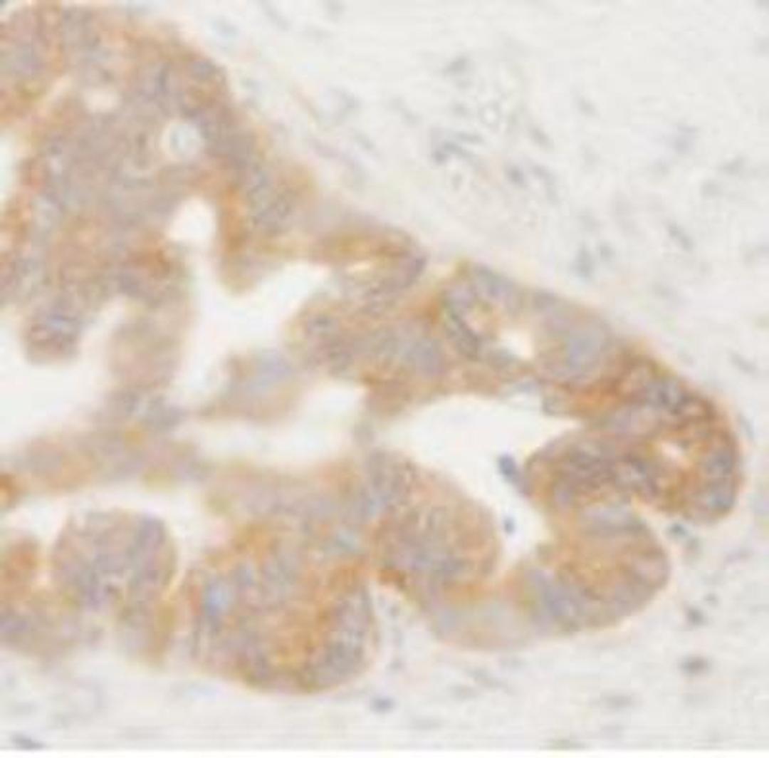 Immunohistochemistry-Paraffin: CDT1 Antibody [NB100-2567] - FFPE section of human ovarian tumor.