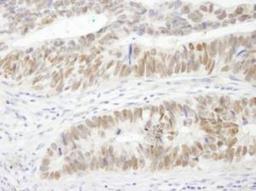 Immunohistochemistry-Paraffin: DRIL1 Antibody [NB100-279] - FFPE section of human colon carcinoma.   Affinity purified rabbit anti-DRIL1 used at a dilution of 1:250.  Detection: DAB staining using Immunohistochemistry Accessory Kit