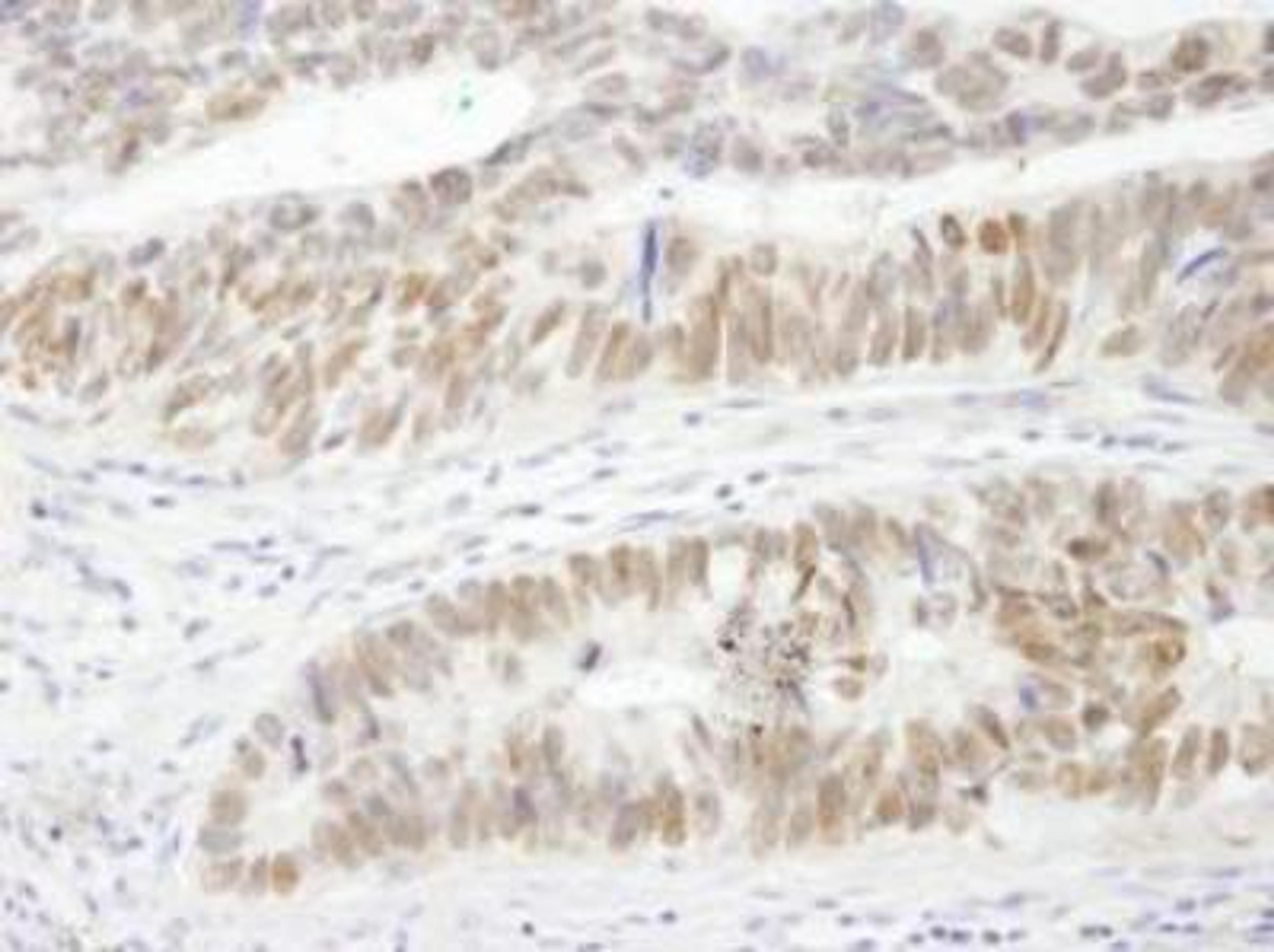 Immunohistochemistry-Paraffin: DRIL1 Antibody [NB100-279] - FFPE section of human colon carcinoma.   Affinity purified rabbit anti-DRIL1 used at a dilution of 1:250.  Detection: DAB staining using Immunohistochemistry Accessory Kit