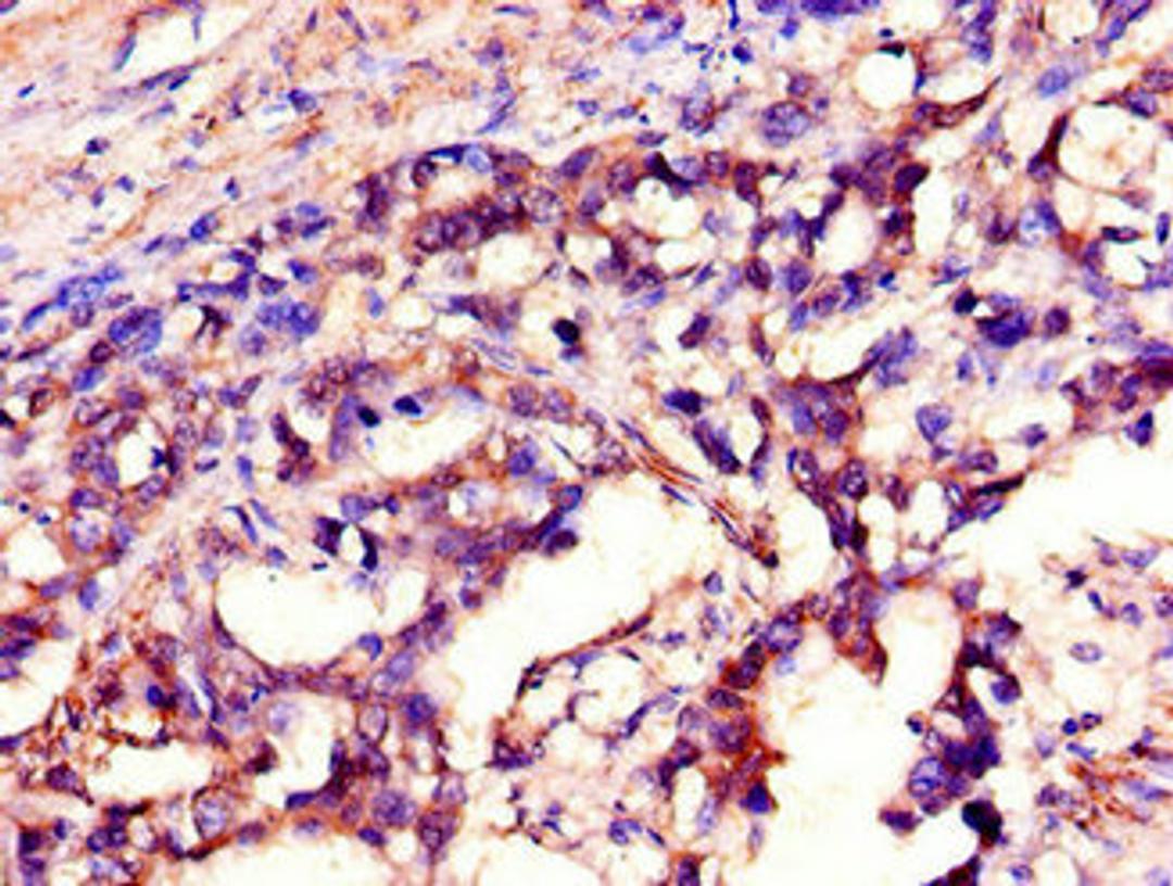 Immunohistochemistry of paraffin-embedded human gastric cancer using CSB-PA021209LA01HU at dilution of 1:100