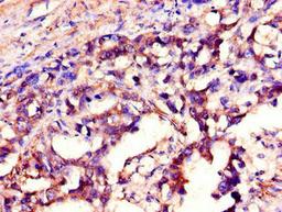 Immunohistochemistry of paraffin-embedded human gastric cancer using CSB-PA021209LA01HU at dilution of 1:100