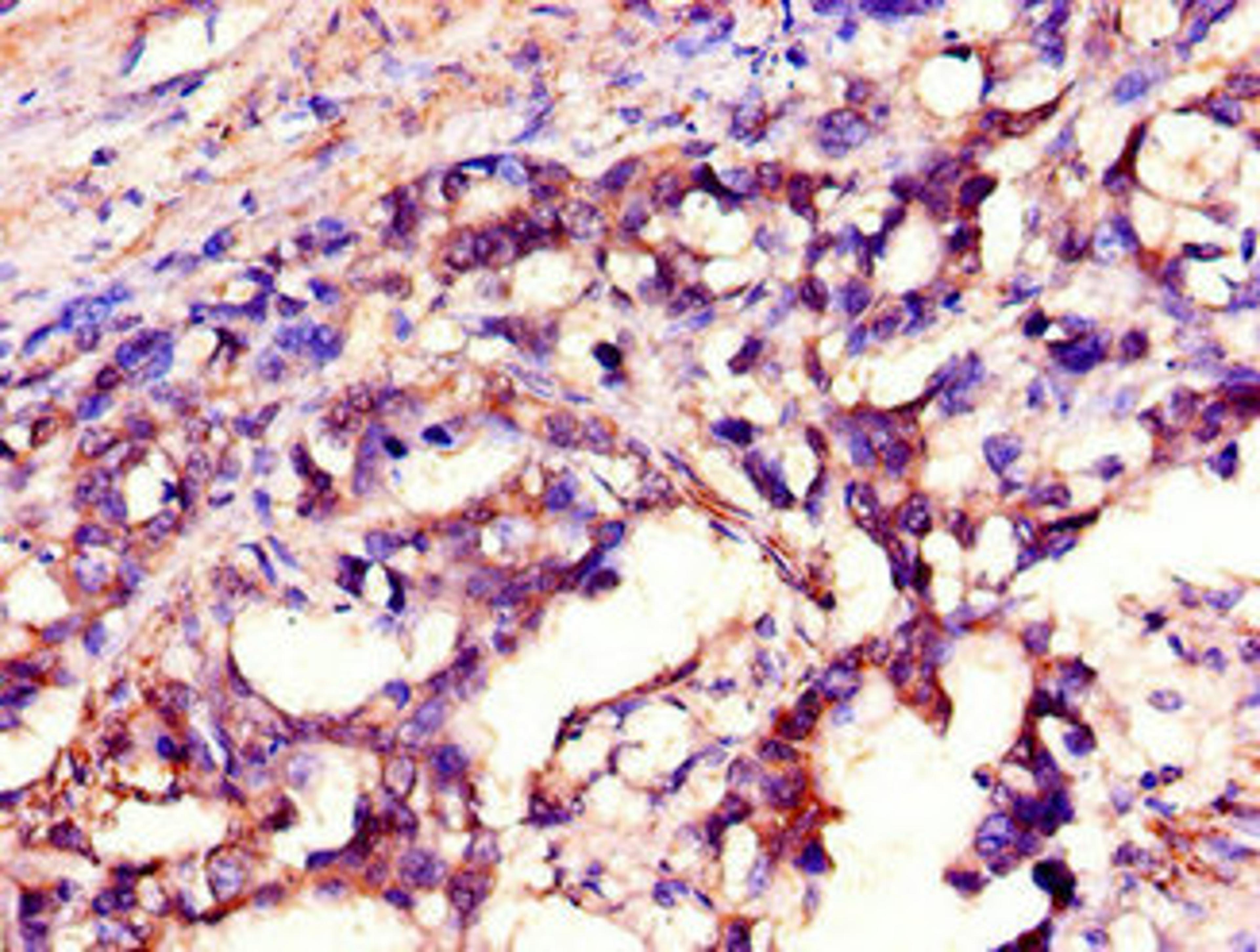 Immunohistochemistry of paraffin-embedded human gastric cancer using CSB-PA021209LA01HU at dilution of 1:100