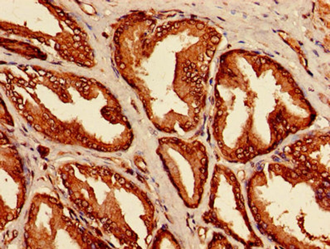 Immunohistochemistry of paraffin-embedded human prostate cancer using CSB-PA013175HA01HU at dilution of 1:100