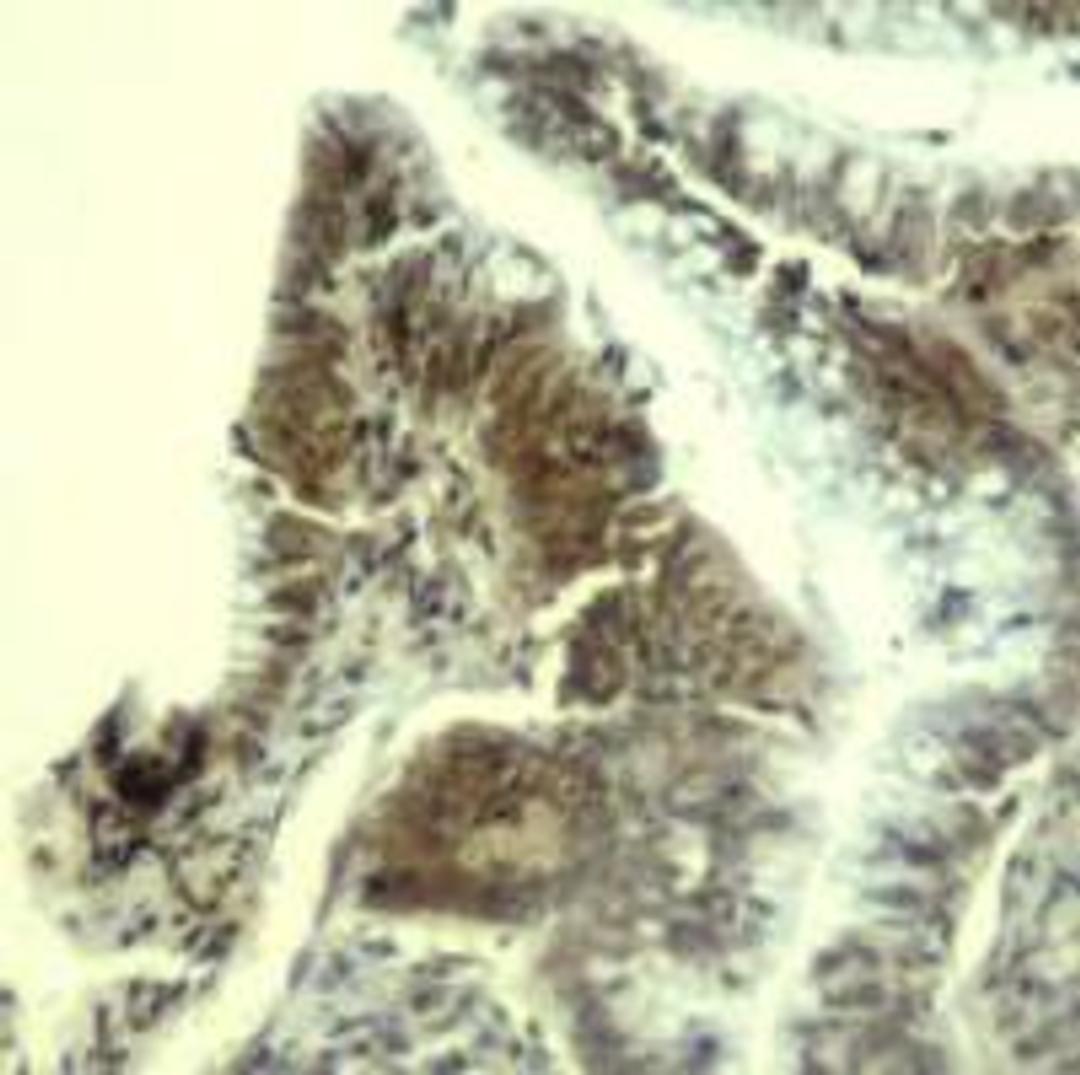 Immunohistochemical analysis of paraffin-embedded human colon carcinoma tissue using CDK6 (Ab-13).