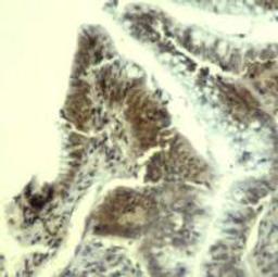 Immunohistochemical analysis of paraffin-embedded human colon carcinoma tissue using CDK6 (Ab-13).