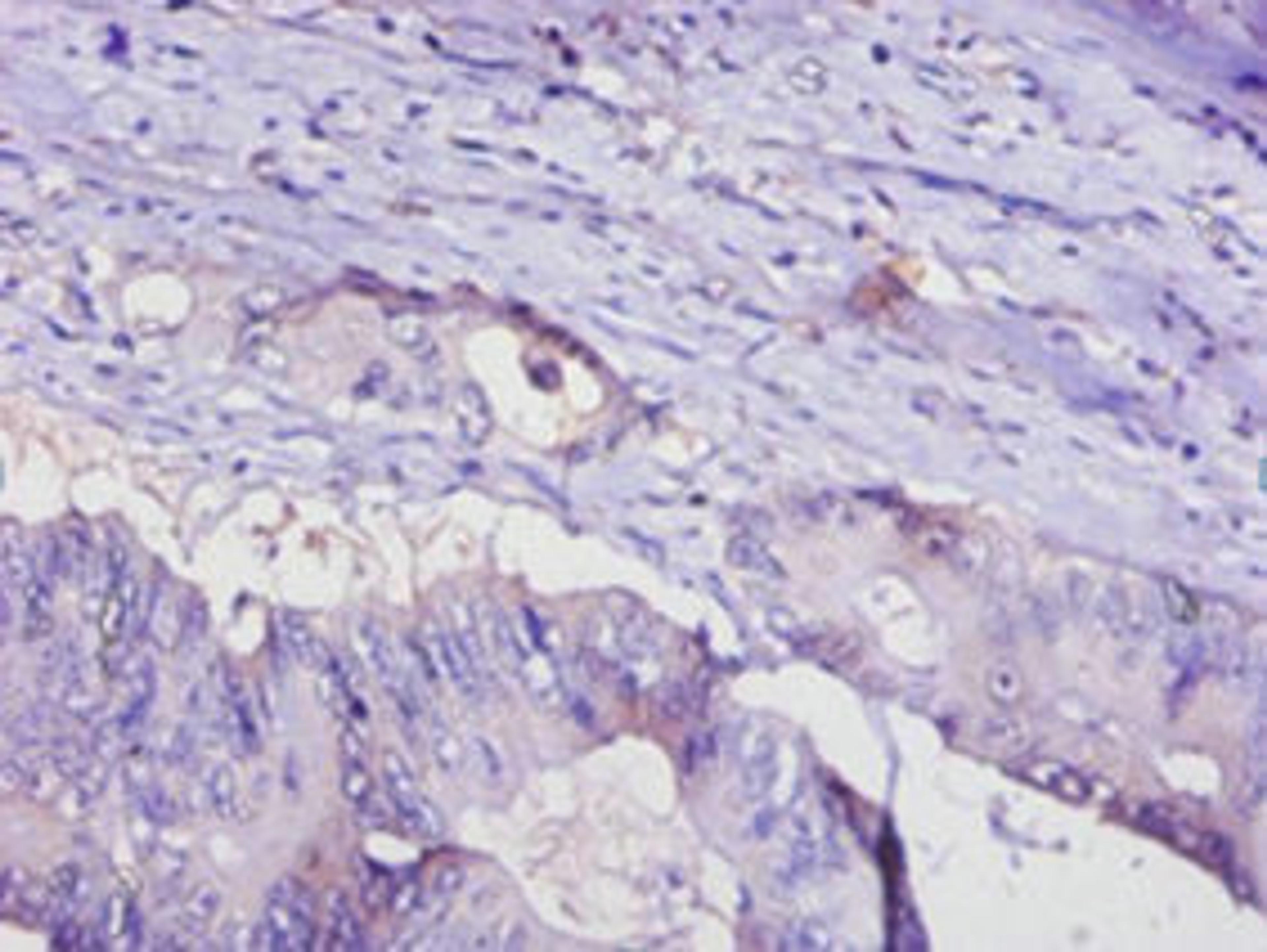 Immunohistochemistry of paraffin-embedded human colon cancer using CSB-PA07956A0Rb at dilution of 1:100