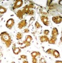 Immunohistochemical analysis of paraffin-embedded human breast carcinoma tissue using NF&#954;B-p65 (Ab-505).