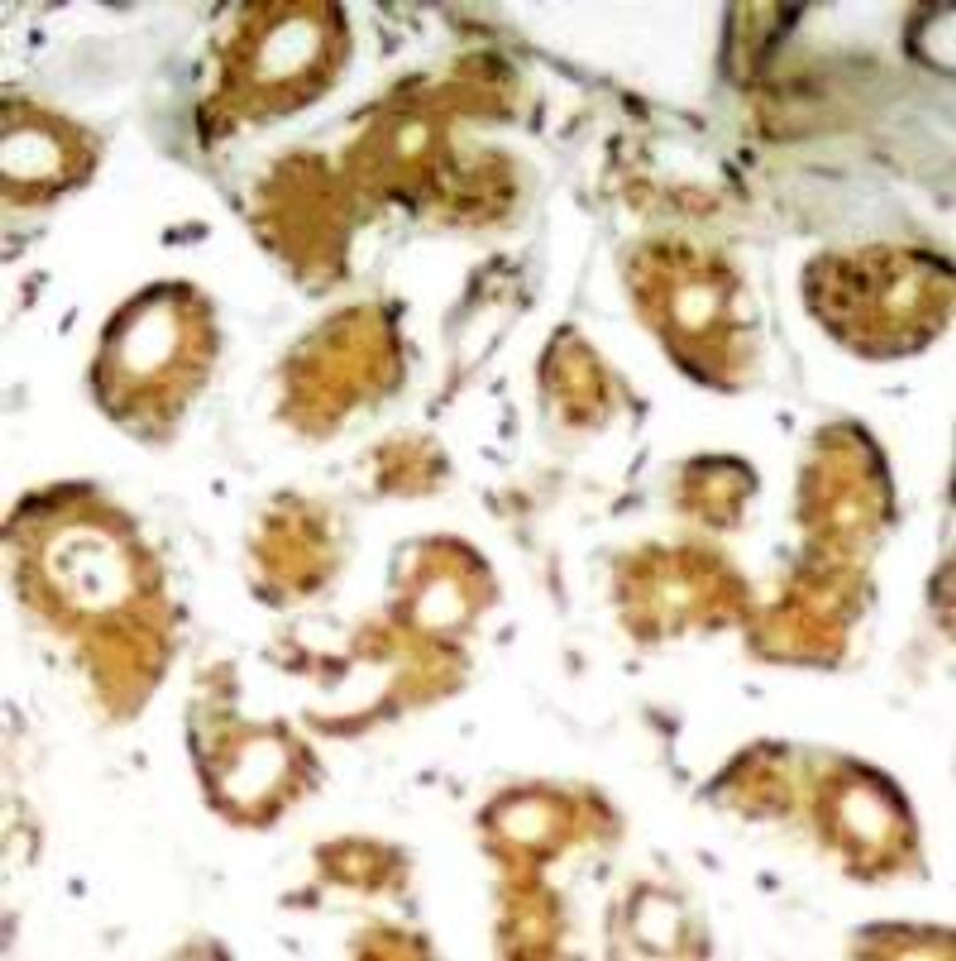 Immunohistochemical analysis of paraffin-embedded human breast carcinoma tissue using NFκB-p65 (Ab-505).