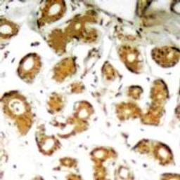 Immunohistochemical analysis of paraffin-embedded human breast carcinoma tissue using NFκB-p65 (Ab-505).