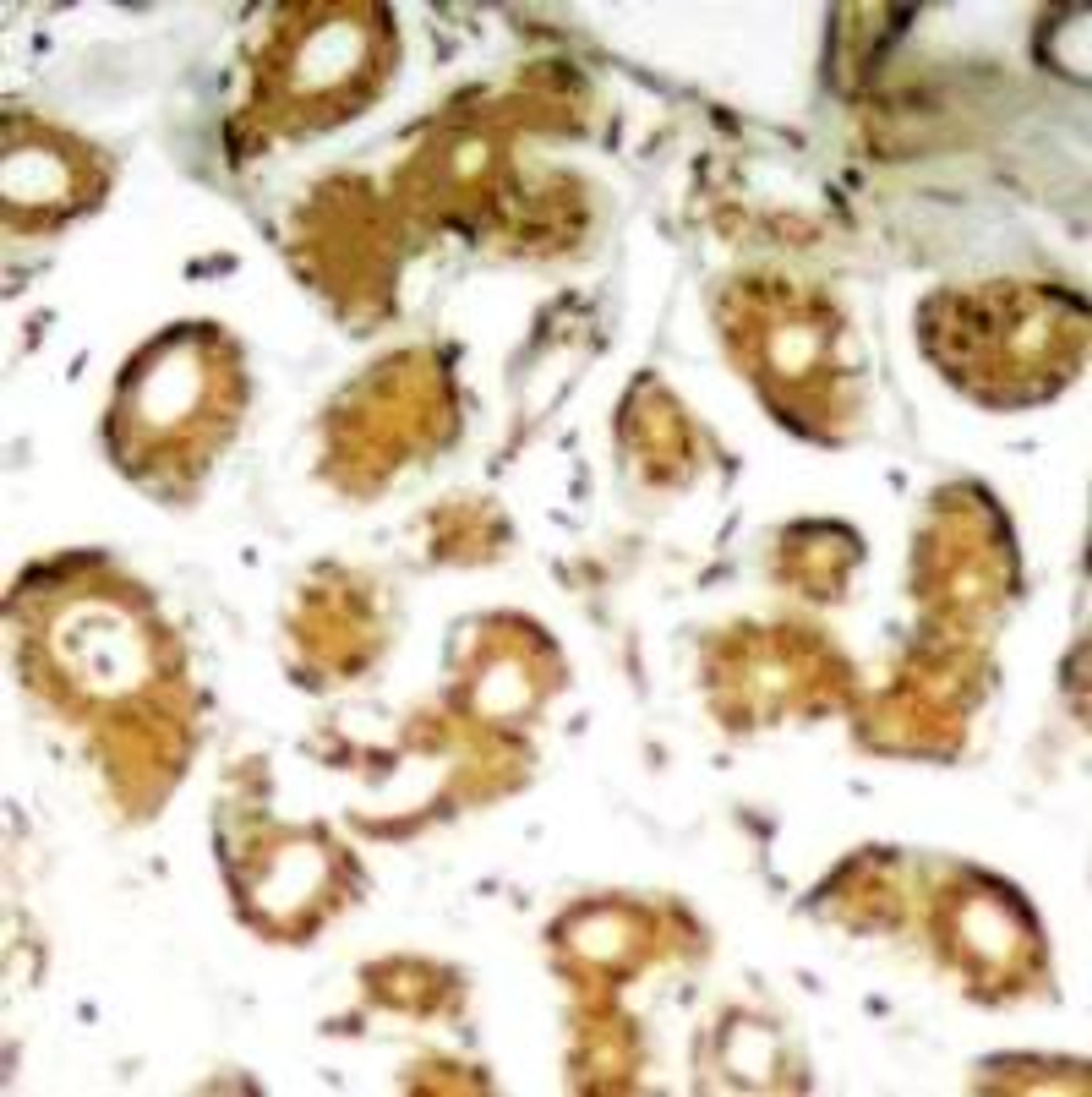Immunohistochemical analysis of paraffin-embedded human breast carcinoma tissue using NFκB-p65 (Ab-505).