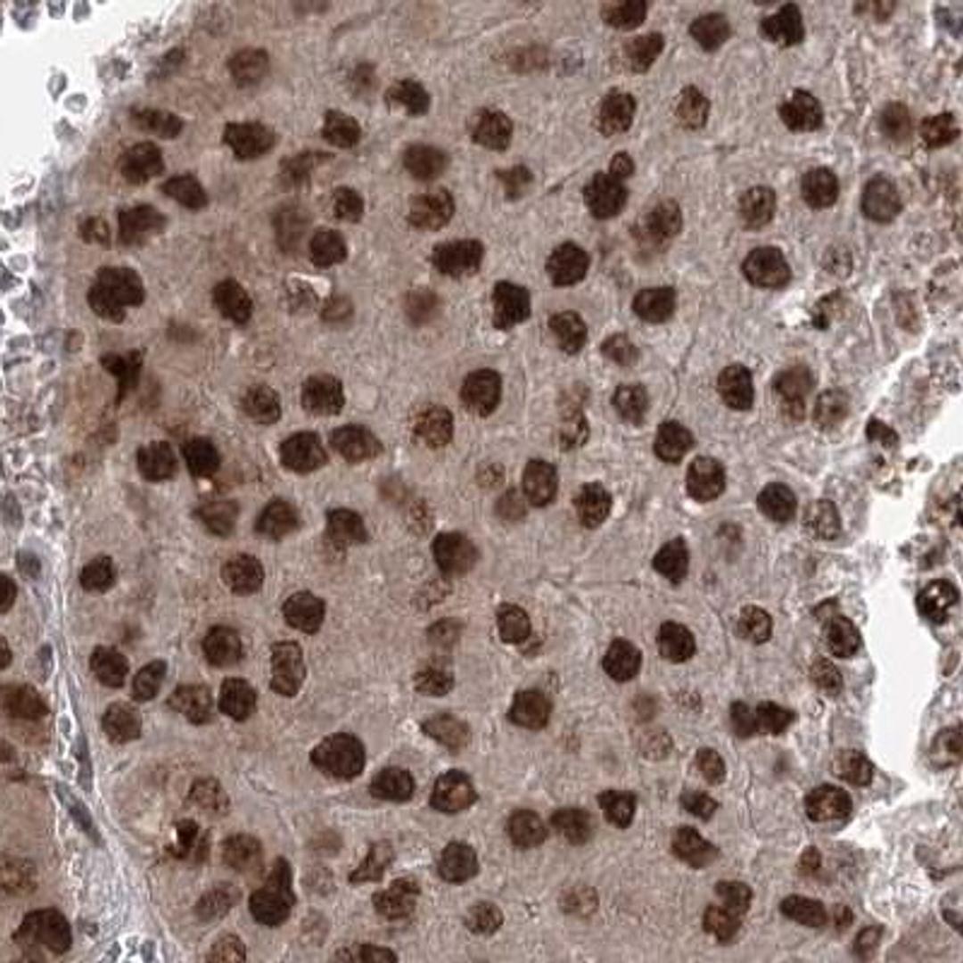 Immunohistochemistry: THYN1 Antibody [NBP2-32645] - liver cancer