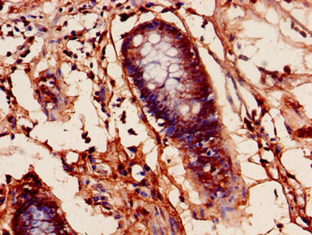 Immunohistochemistry of paraffin-embedded human colon cancer using CSB-PA01485A0Rb at dilution of 1:100