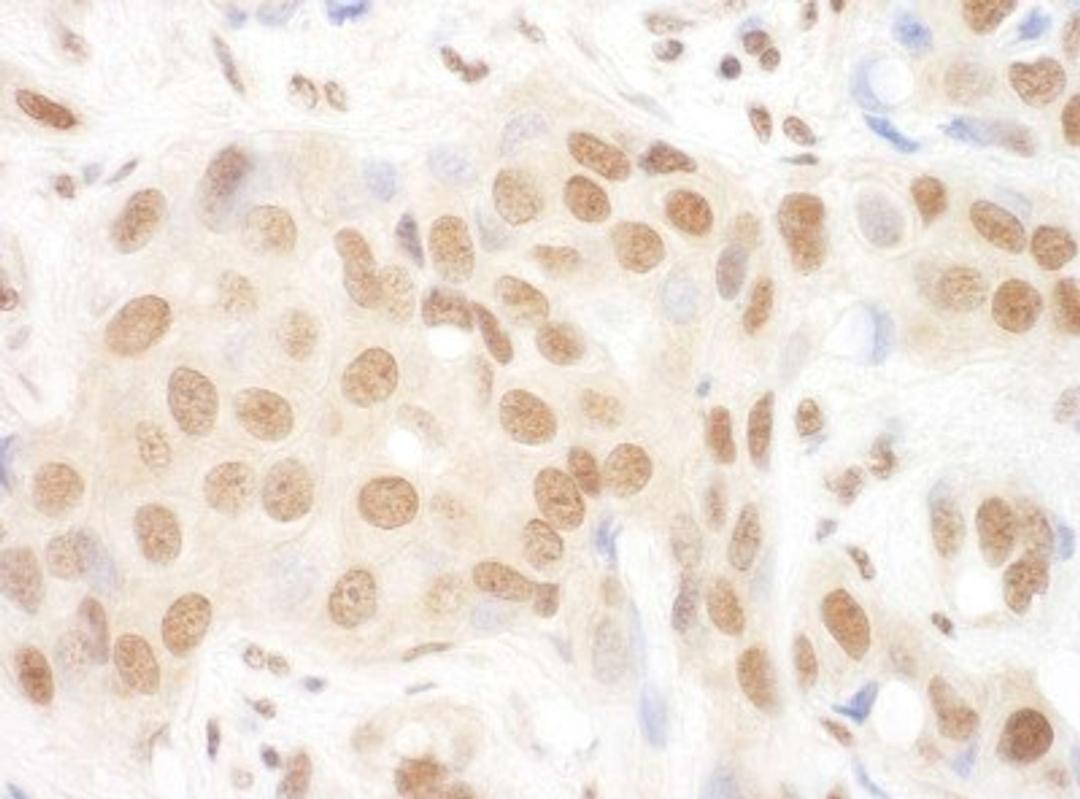 Immunohistochemistry-Paraffin: DGCR8 Antibody [NBP1-30115] - Human breast carcinoma. Antibody used at a dilution of 1:200 (1ug/ml).