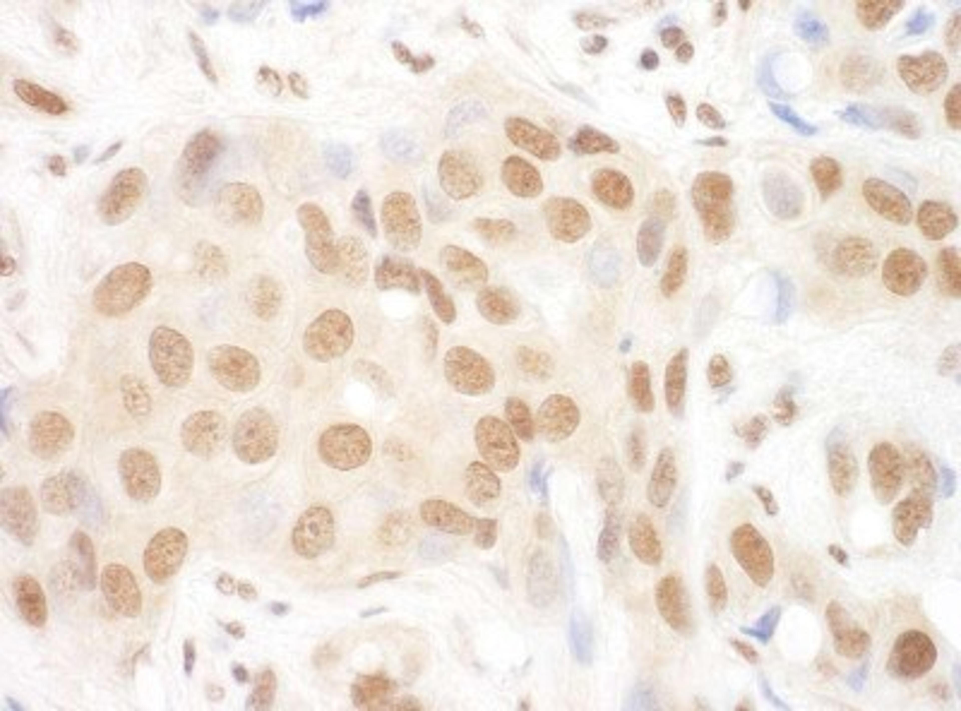 Immunohistochemistry-Paraffin: DGCR8 Antibody [NBP1-30115] - Human breast carcinoma. Antibody used at a dilution of 1:200 (1ug/ml).