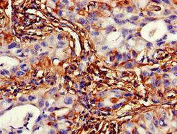 Immunohistochemistry of paraffin-embedded human lung cancer using CSB-PA856940LA01HU at dilution of 1:100