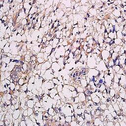 Immunohistochemical analysis of formalin-fixed and paraffin embedded human endometrial cancer (dilution at:1:200) using Oxytocin Receptor antibody