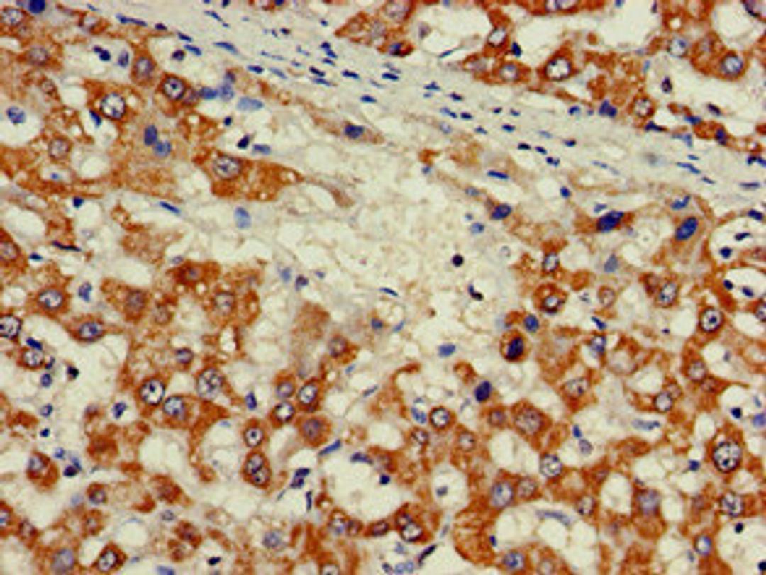 Immunohistochemistry of paraffin-embedded human liver cancer using CSB-PA610840LA01HU at dilution of 1:100
