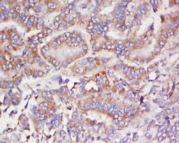 Immunohistochemical staining of human lung carcinoma tissue using FCHSD1 antibody.